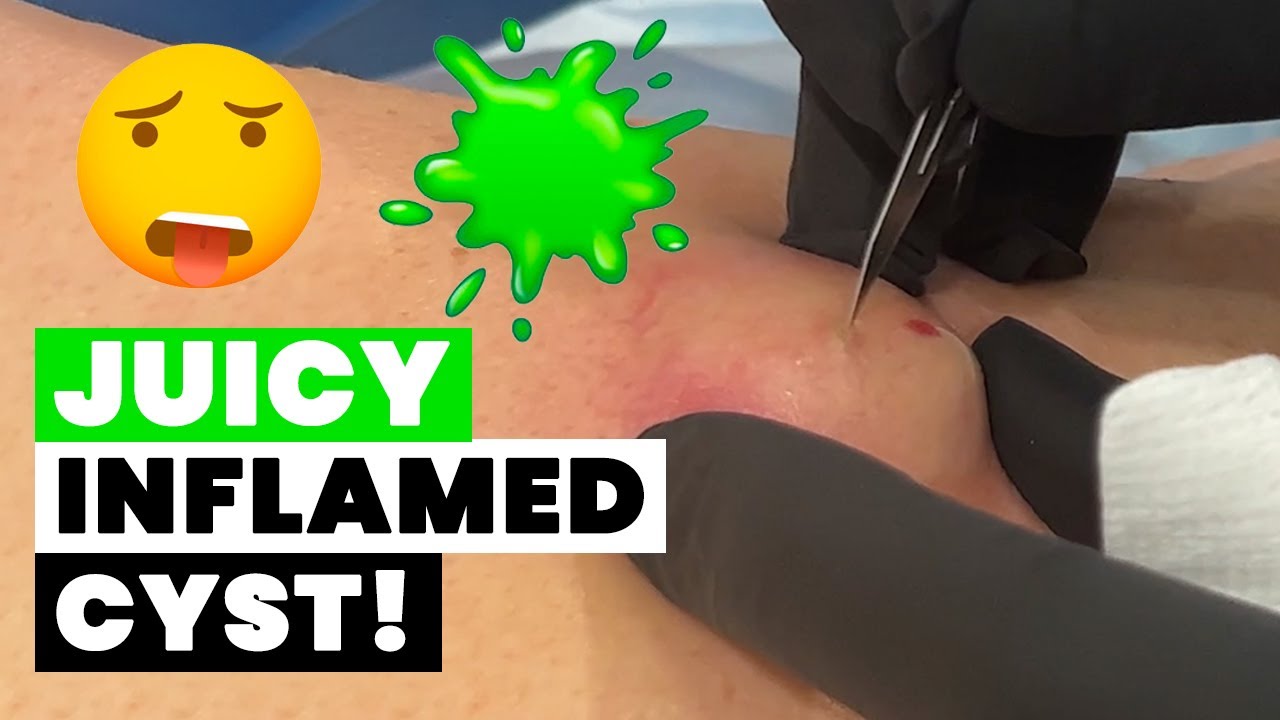 JUICY INFLAMED CYST!
