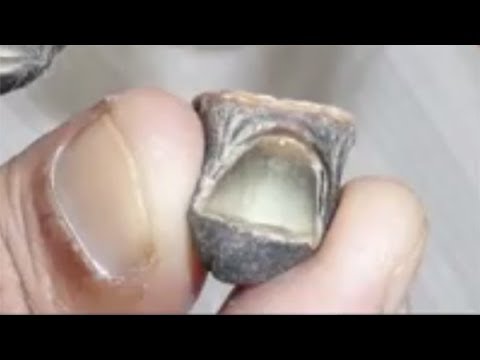 Krokodil, Flesh-Rotting Drug Found In America [GRAPHIC PICTURES]