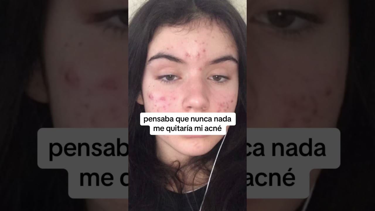 La MEJOR crema antiacne