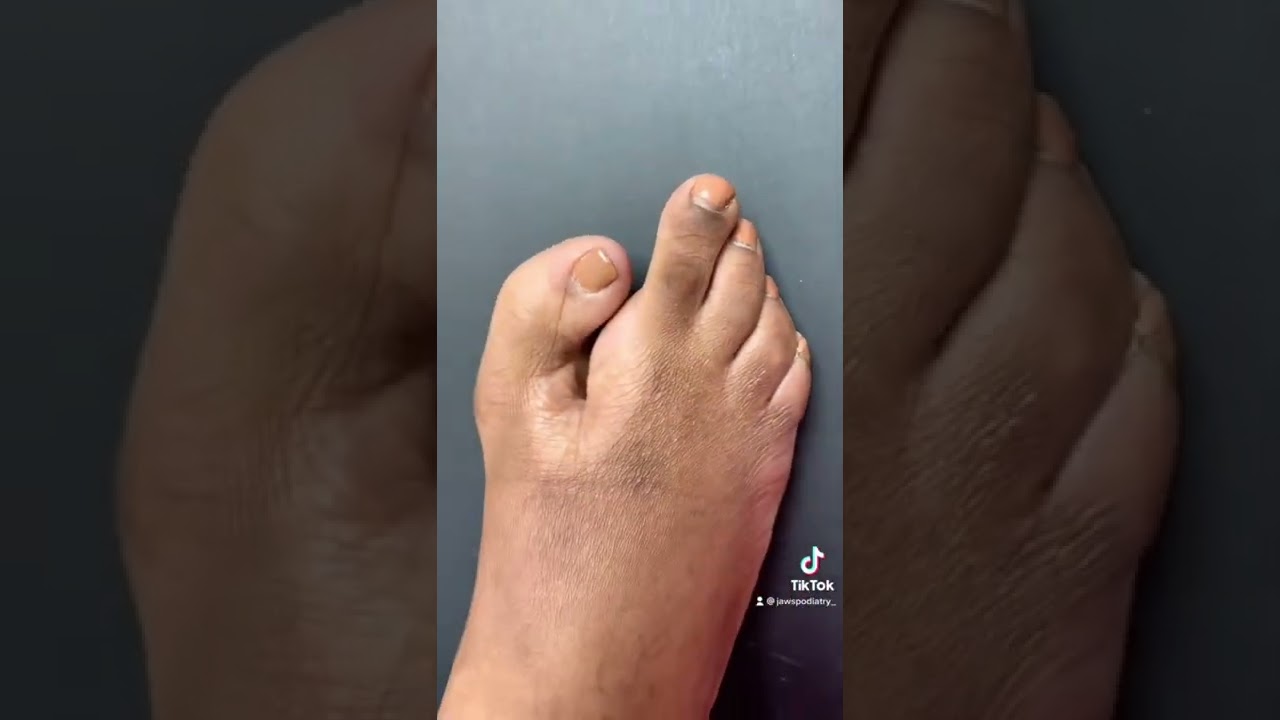 LOBSTER CLAW FOOT 🦞 #shorts #plasticsurgery #feet