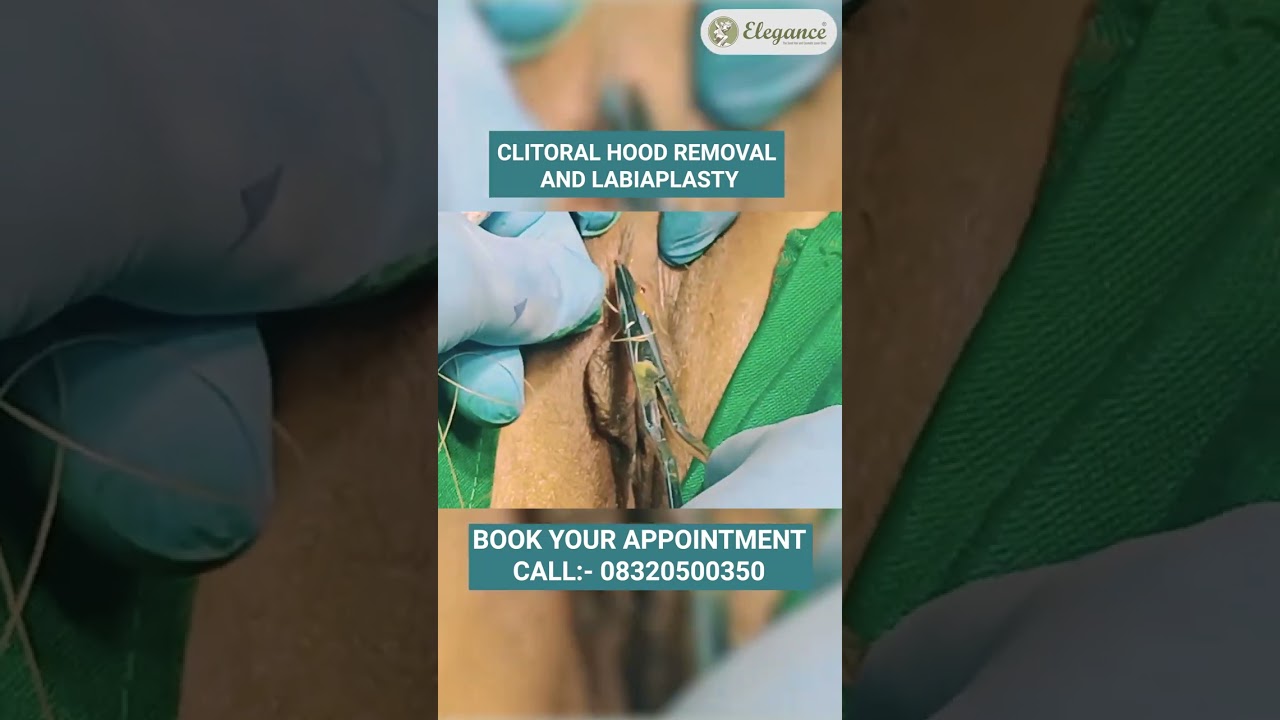 Low Cost Labiaplasty, Vagina Tighten Surgery, Hymenoplasty Treatment in Vesu, Athwagate, Surat