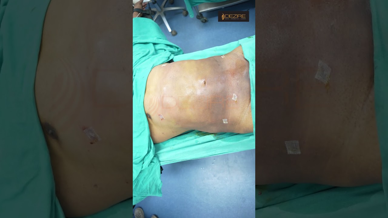 Male Abdomen Liposuction