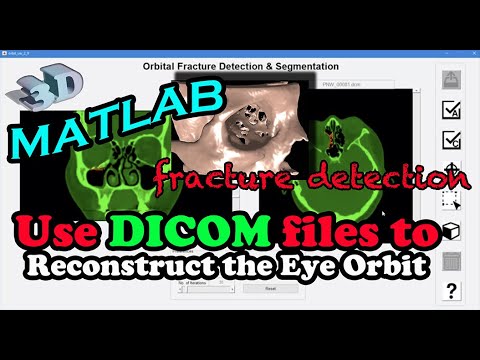 【MATLAB - 3D Reconstruction】Using DICOM files to reconstruct patient's eye orbit