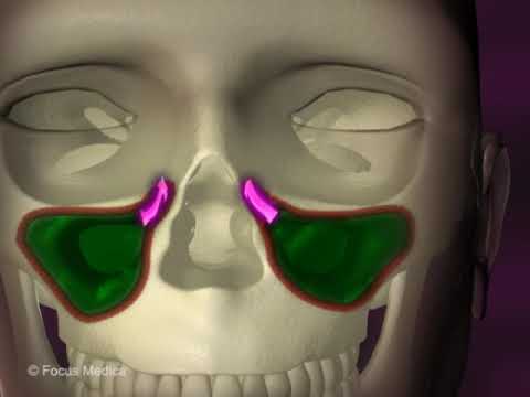 Maxillary sinus-Otolaryngology