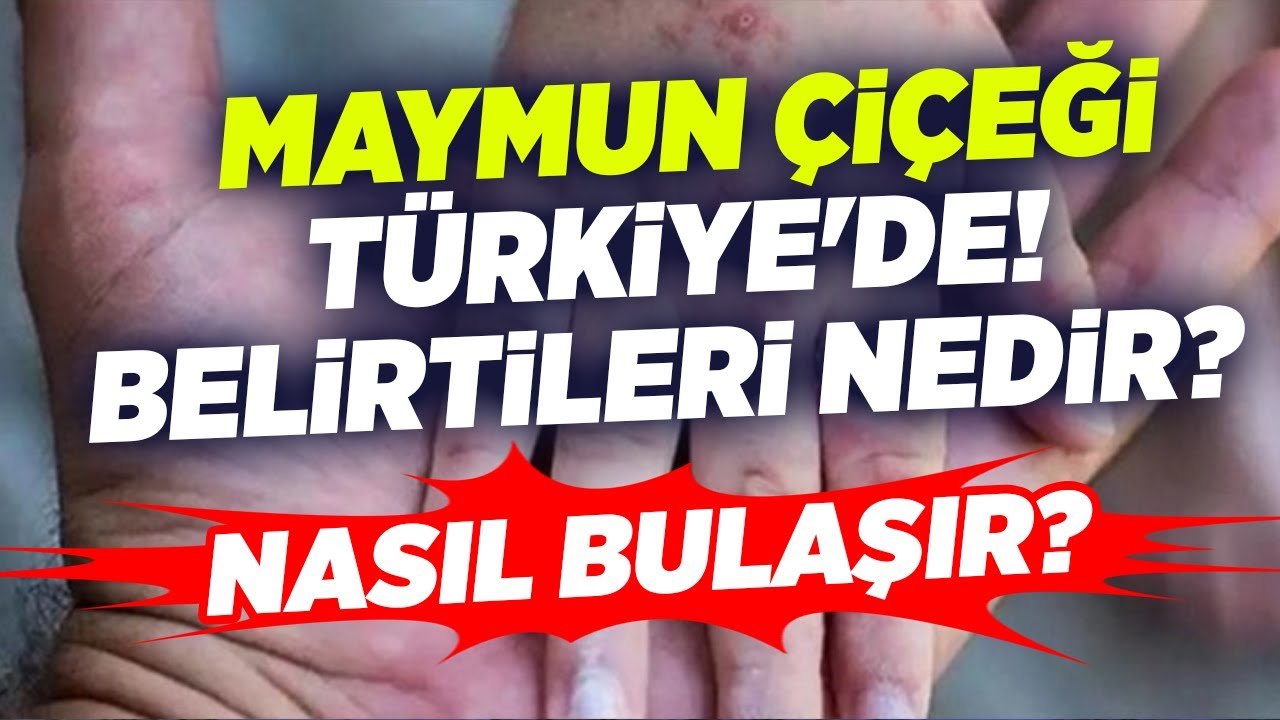 Maymun Çiçeği Türkiye'de! Maymun Çiçeği Belirtileri Nedir? Nasıl Bulaşır? Dr. Bülent Ertuğrul KRT TV