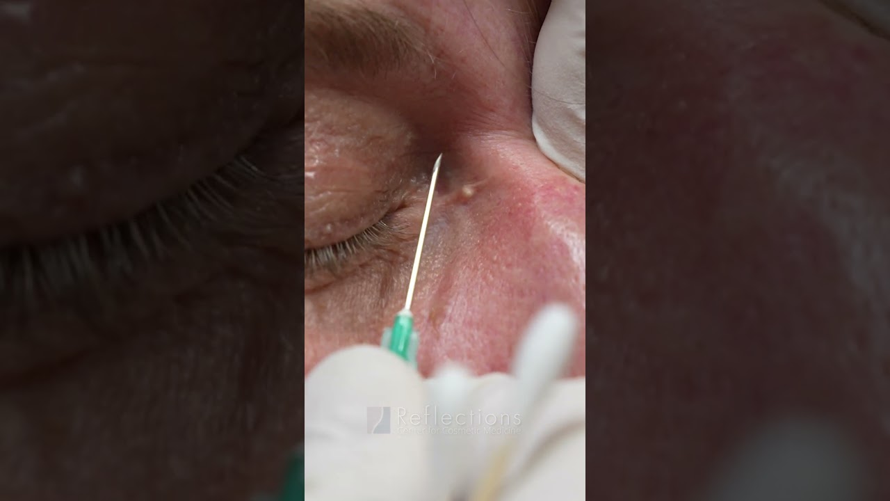 Milia Removal