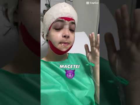 Minha CIRURGIA facial 💉