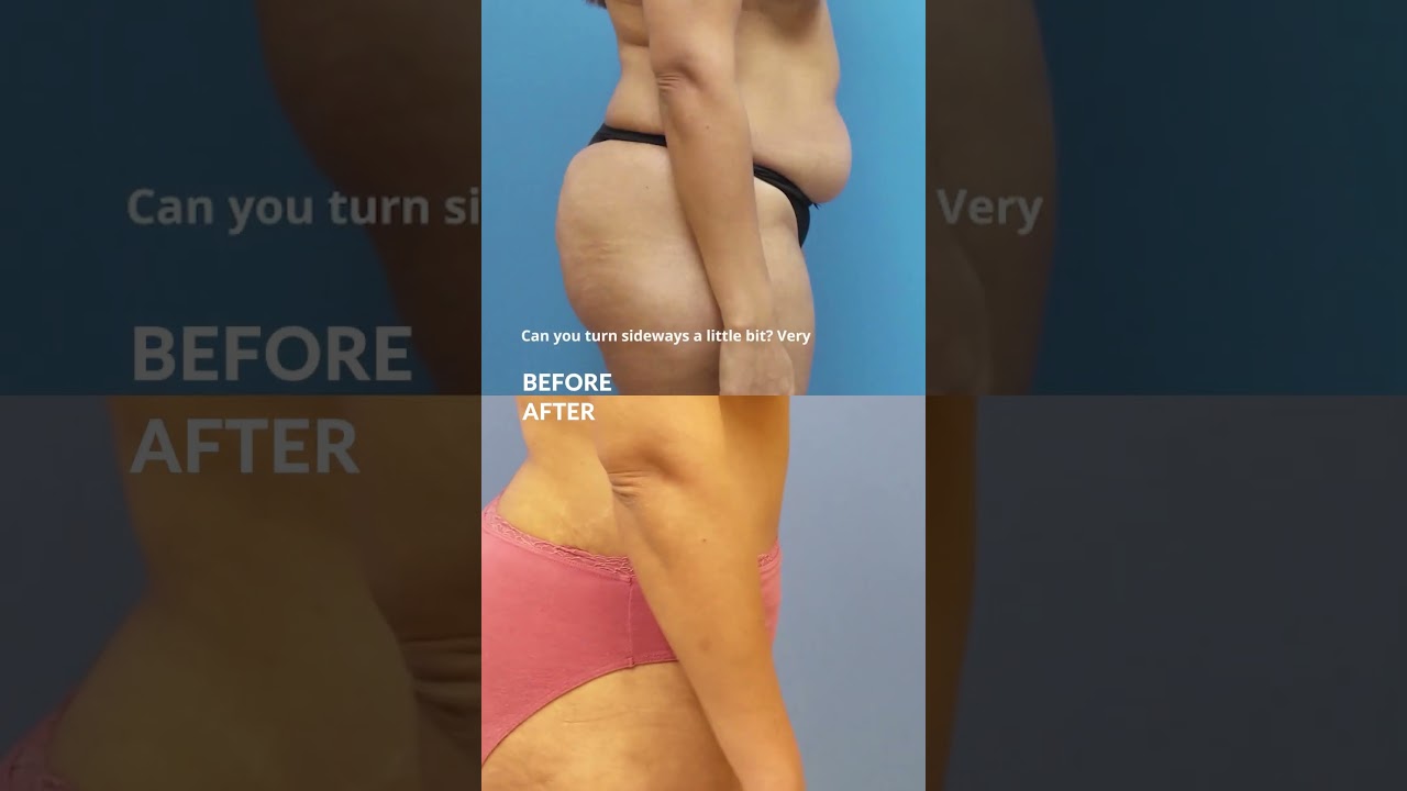 Mommy Makeover results 4 months postop #shorts #mommymakeover #lipo #tummytuck