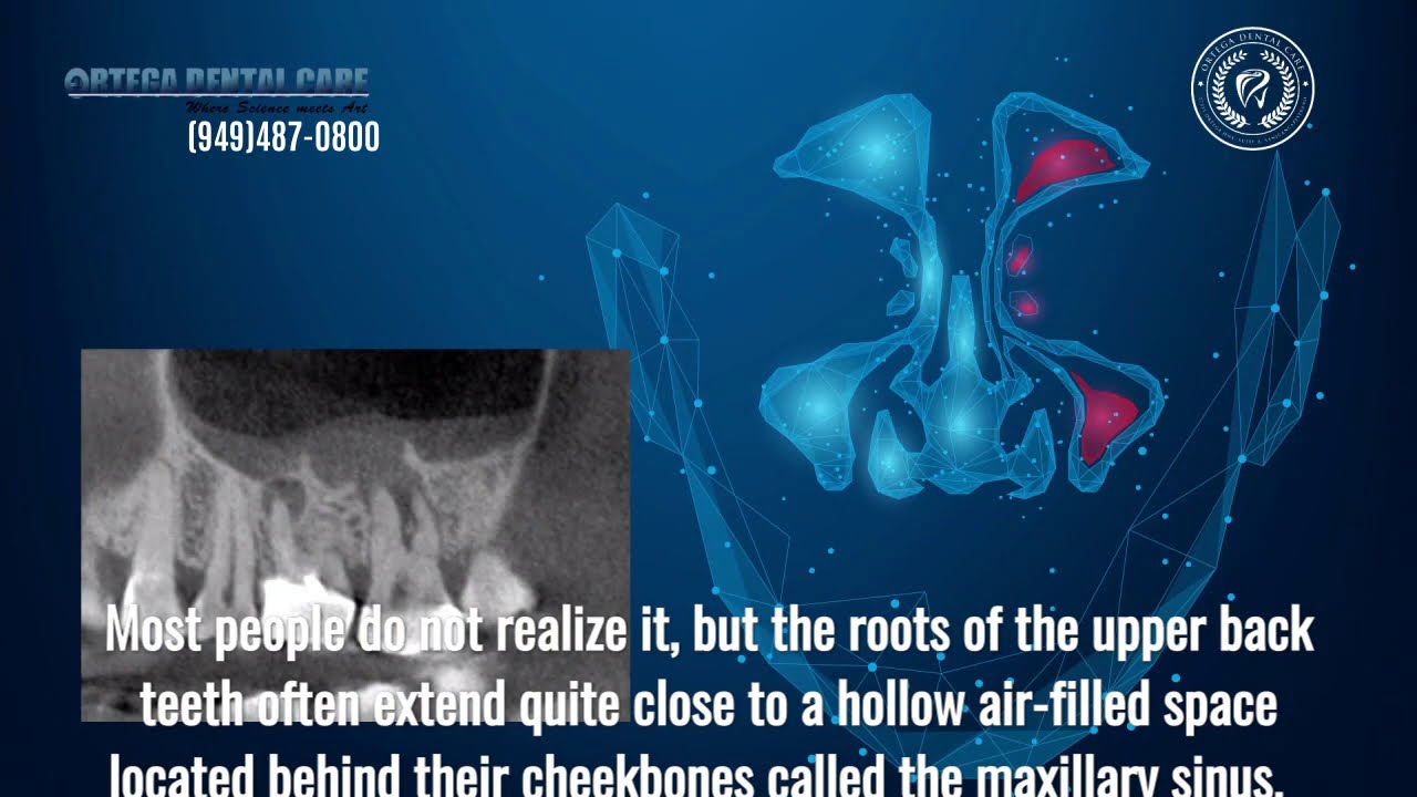 MSEO-maxillary-sinusitis-of-endodontic-origin. Ortega Dental Care
