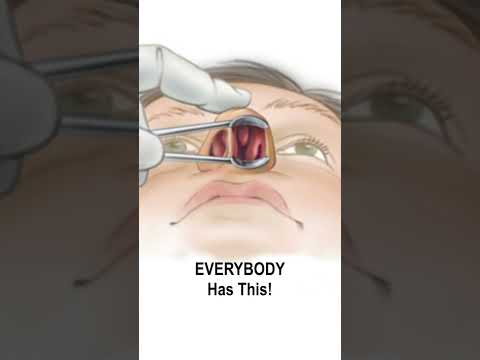 Nasal Obstruction Due to Turbinate Hypertrophy #shorts @fauquierent