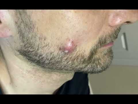 🤯Oddly Satisfying pimple pop?🥴 Neo-Derm Clinic