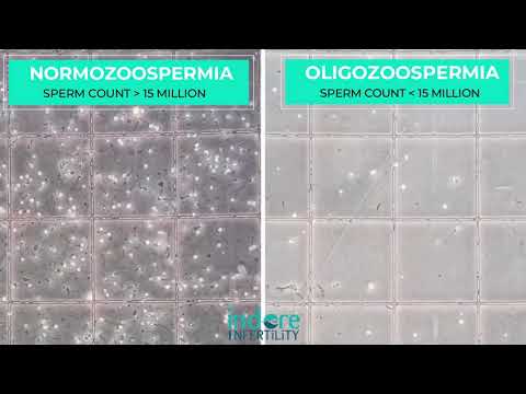 Oligozoospermia - Low Sperm Count. Comparison of Normal Semen Sample with sample with Low Count.