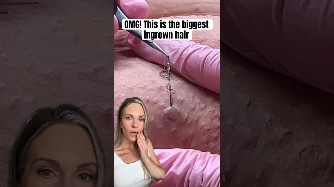 OMG! THIS IS THE WORLDS BIGGEST INGROWN HAIR REMOVAL! #shorts