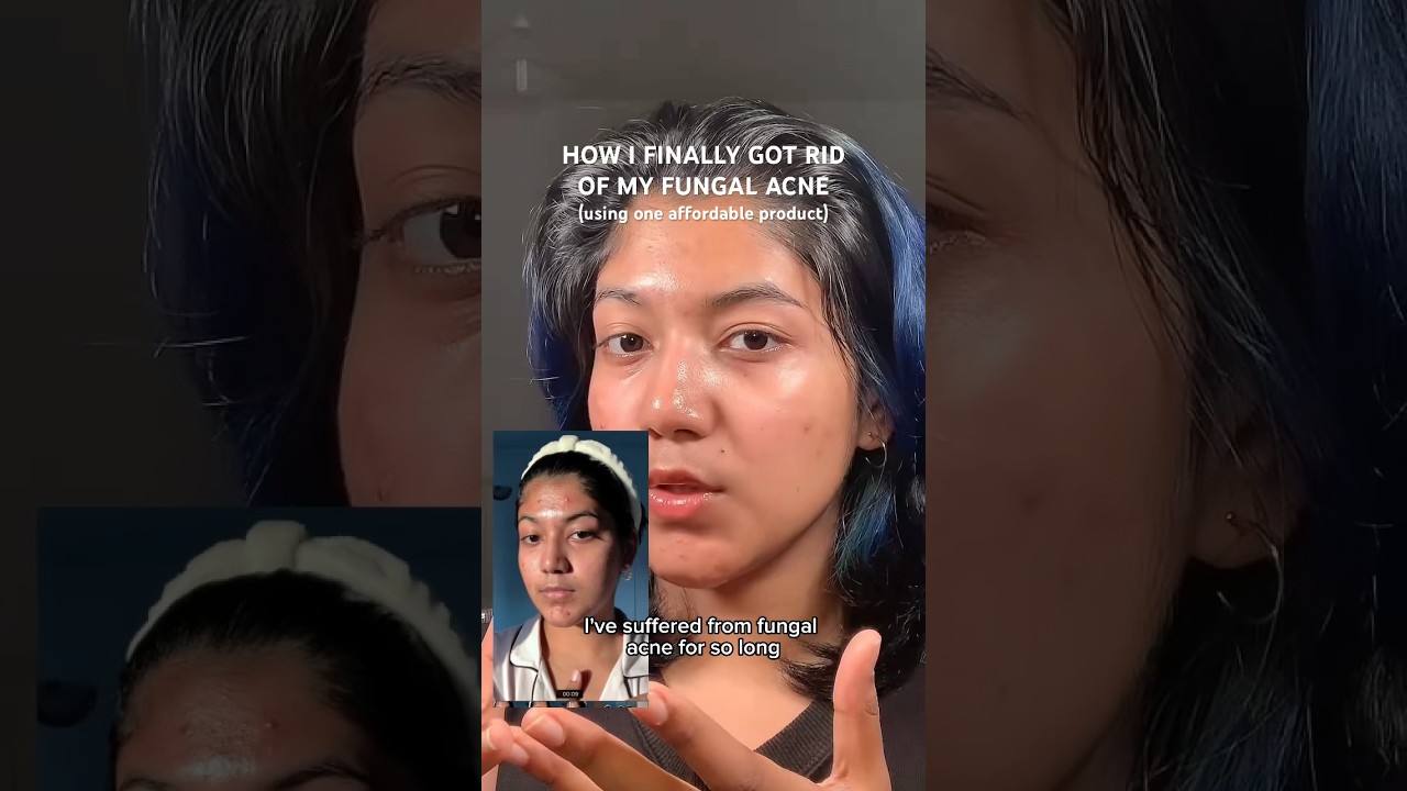 One product that helped me clear my fungal acne!! | #skincare #skincaretips #acnetreatment