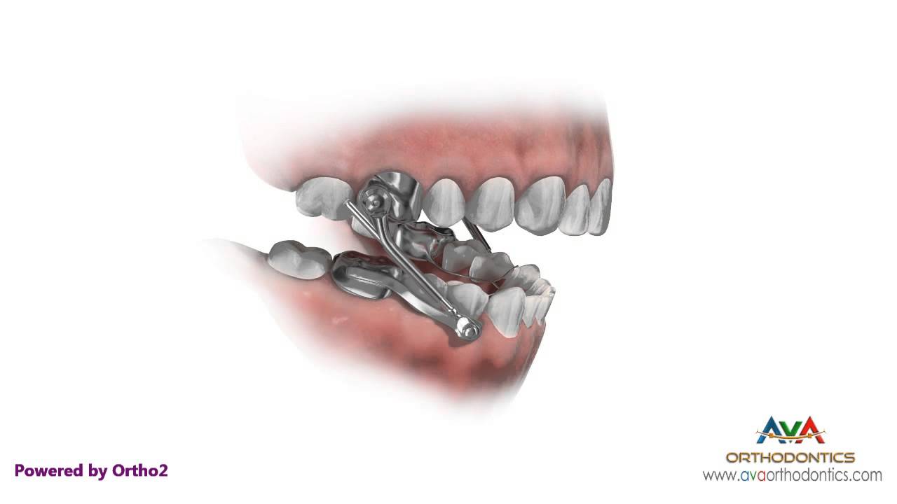 Orthodontics Treatment for Overjet (Overbite) - Herbst Appliance