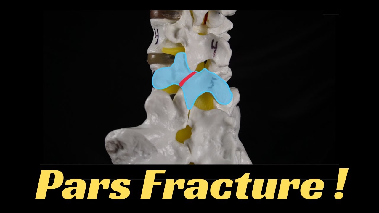Pars fracture