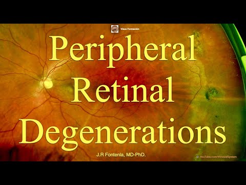 Peripheral Retinal Degenerations.