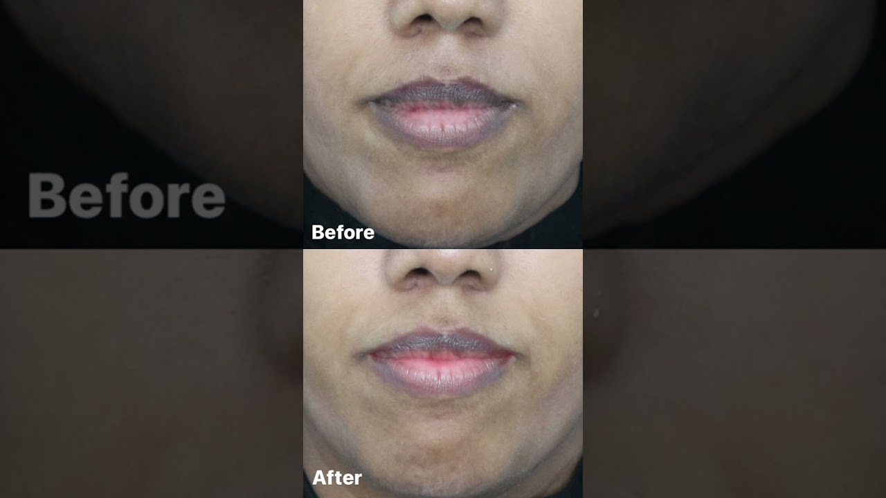 Pink Lips Laser