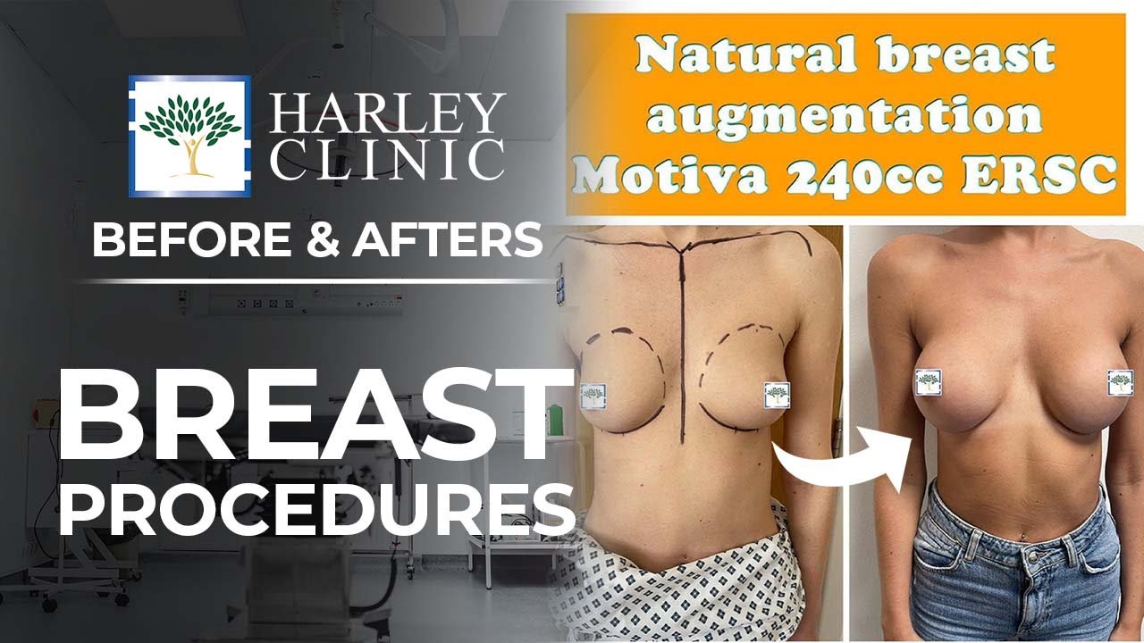 Plastic Surgery Breast Augmentation Before & Afters | Harley Clinic (Vol 2)