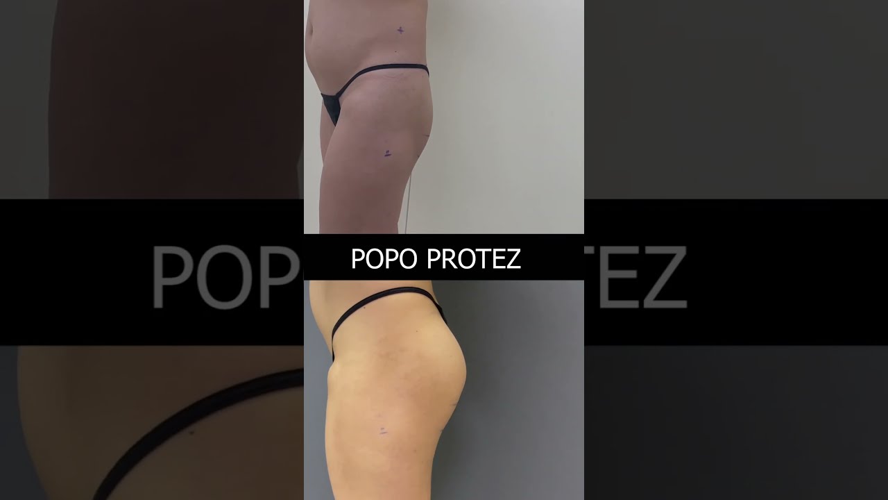 Popo Protez Ameliyatı II  Öncesi Sonrası #shorts