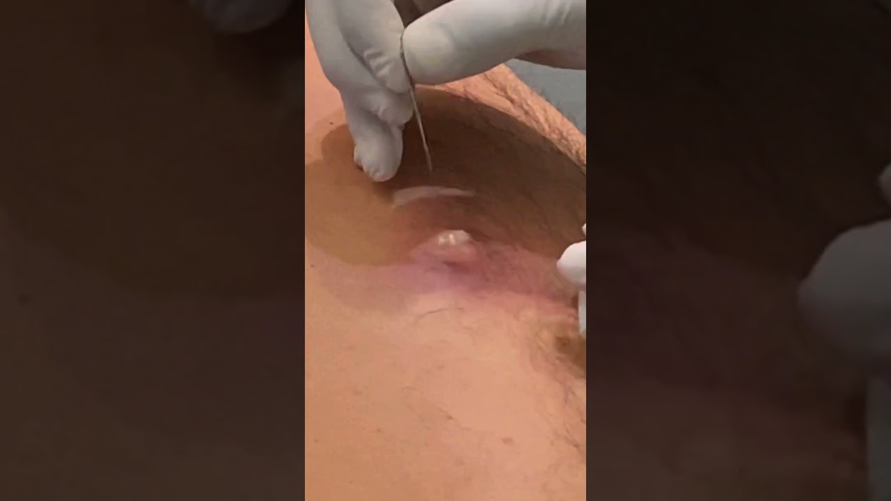 PUS-FILLED ABSCESS!