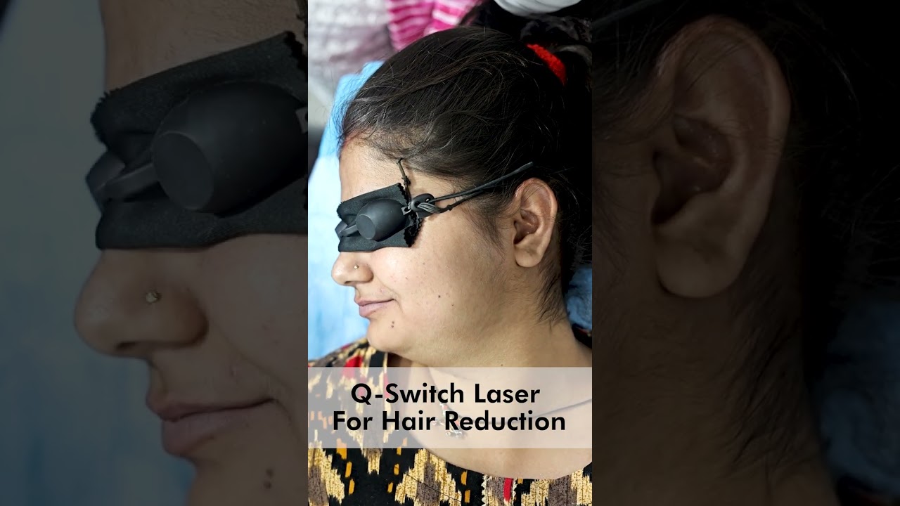 Q-Switch Laser For Hair Reduction | Facial Hair Removal Using Laser | Skinaa Clinic #shorts