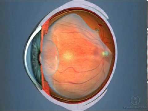 Retinal Holes