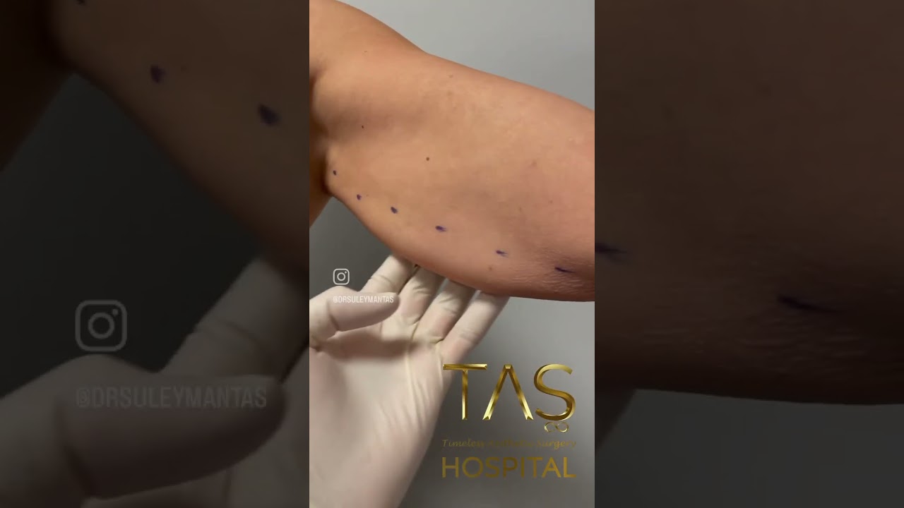 Revolutionary Scarless Arm Lift: Achieve Toned Arms with Dr. TAS