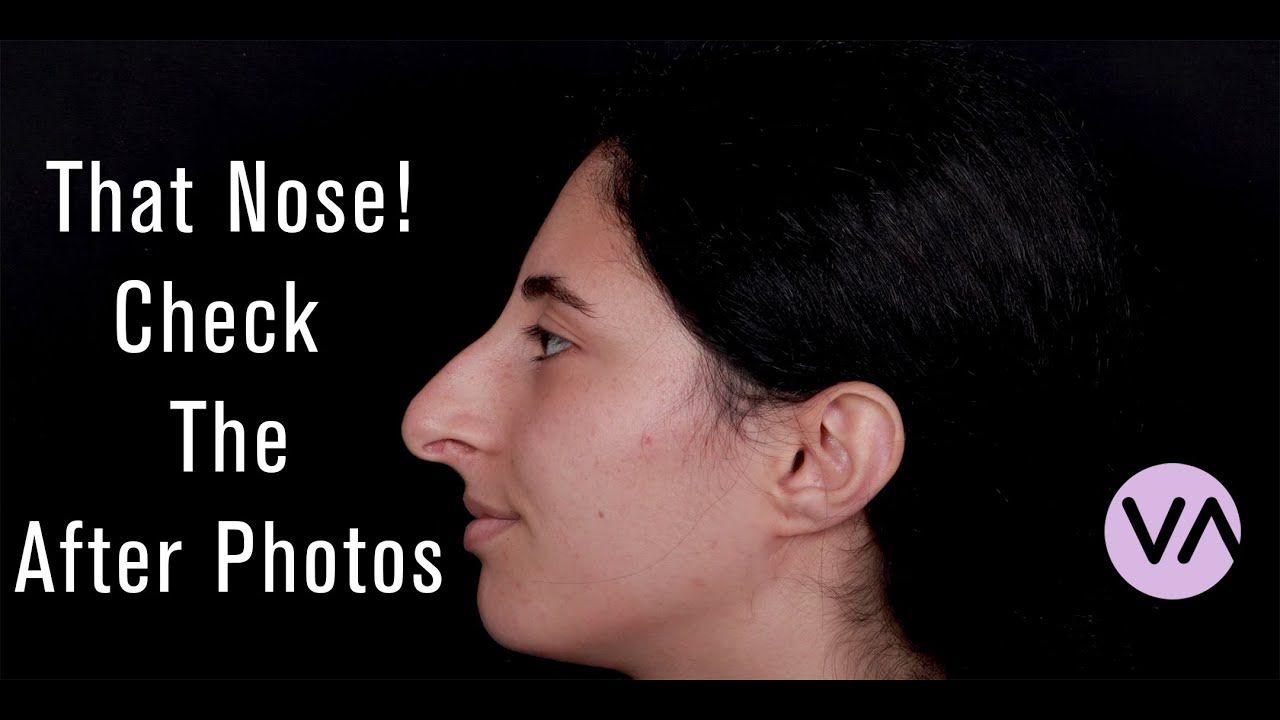 Rhinoplasty - Amazing Before After Photos from Vanity #rhinoplasty #nosejob