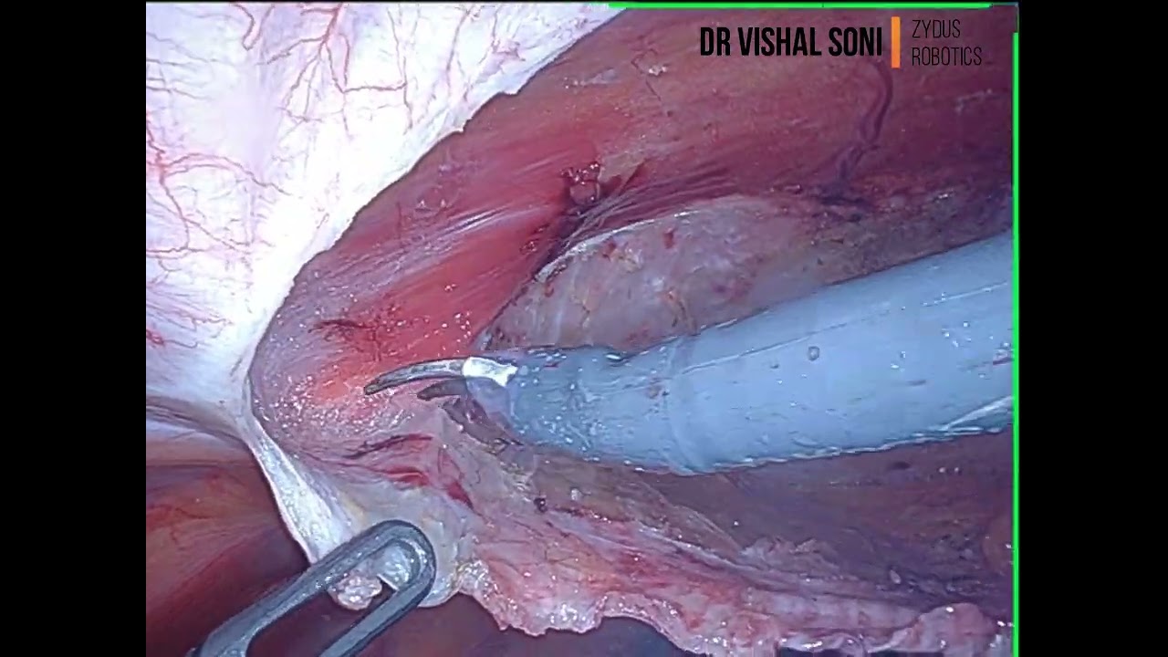 Robotic TARUP Meshplasty