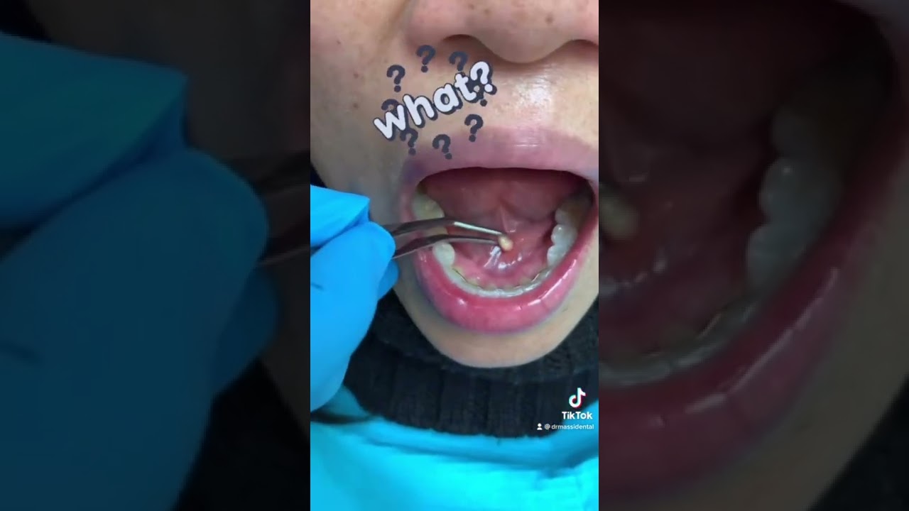 Salivary Gland Stone #tiktok #dentist #goodvibes #family #viral #video #fyp #foryou #trending