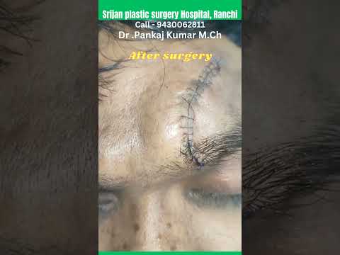 Scar revision surgery of forehead scar #shorts #scartreatment