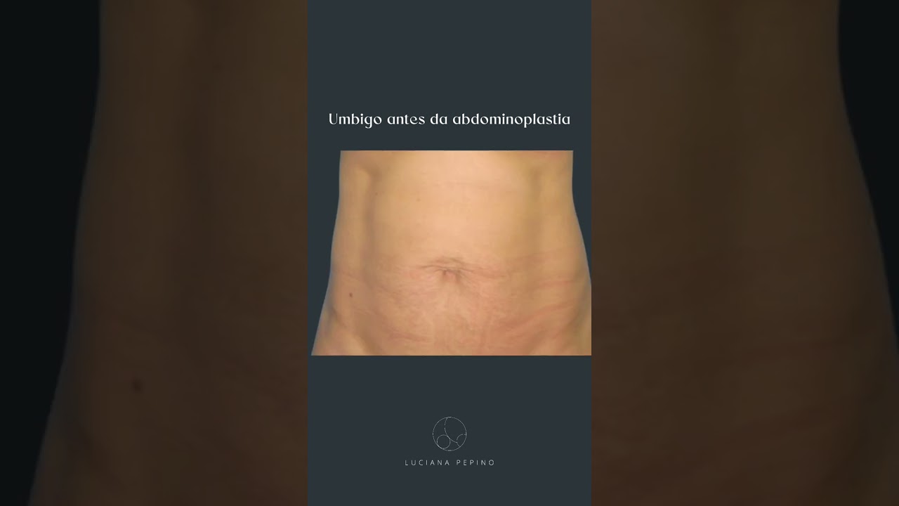 Será mesmo que o umbigo de abdominoplastia é feio? 🙈
