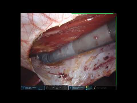 TARUP HERNIA REPAIR