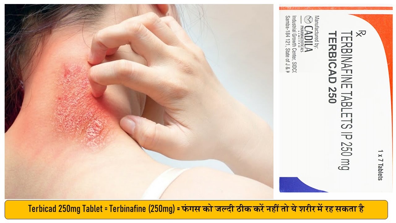 Terbicad 250mg Tablet = Terbinafine (250mg) = Treat Fungal Infection फंगल इन्फेक्शन में उपयोगी