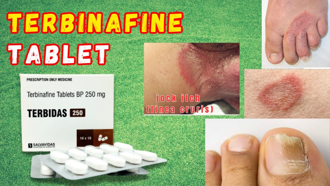 Terbinafine Tablet | Terbinafine (Antifungal Drug) | Terbinafine Tablets ip 250 mg