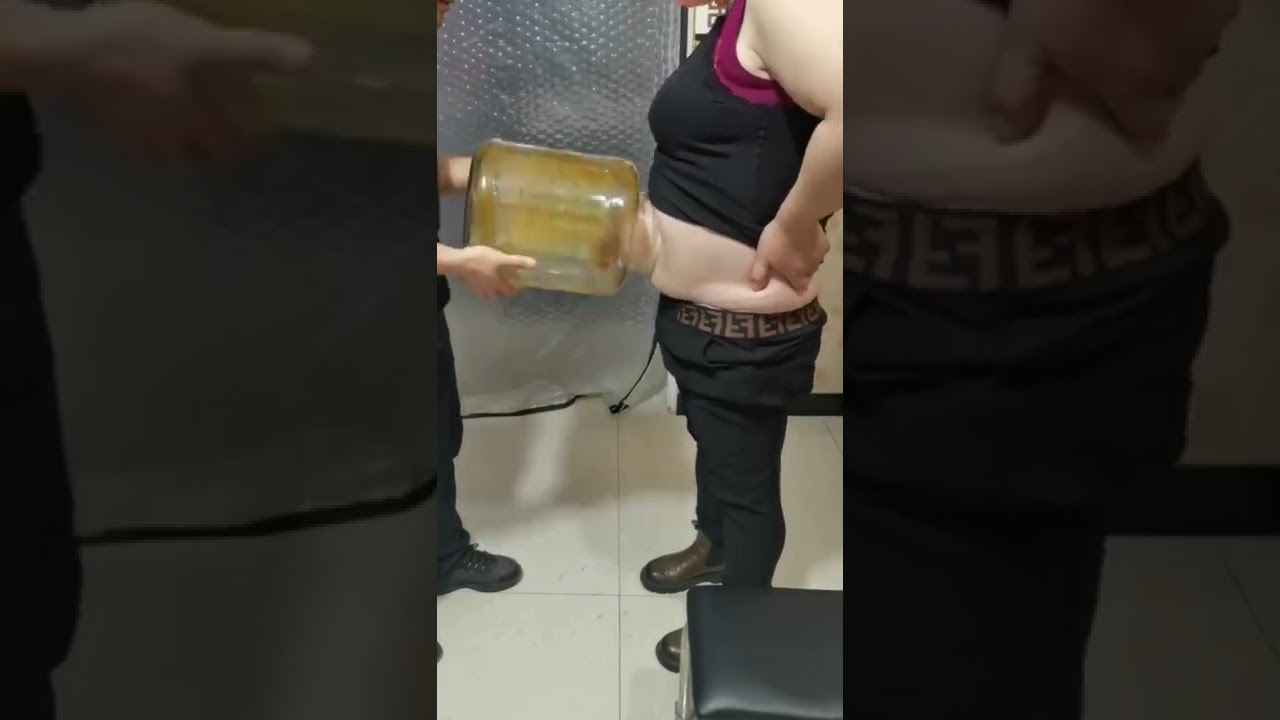 The magic cupping therapy