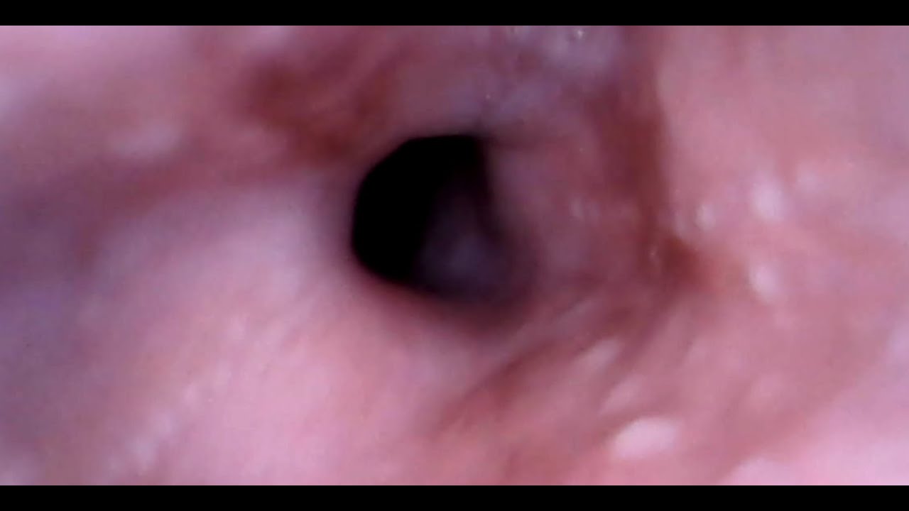 throat endoscopy