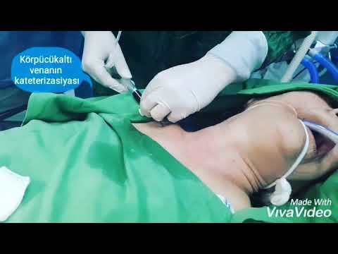 Topçubaşov ad.ECM. KATETERİZASİYA
