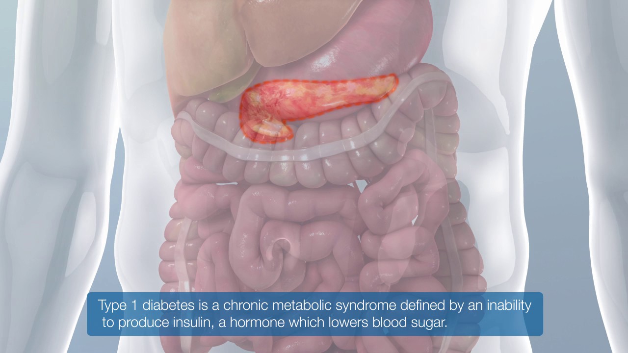 TYPE 1 DIABETES