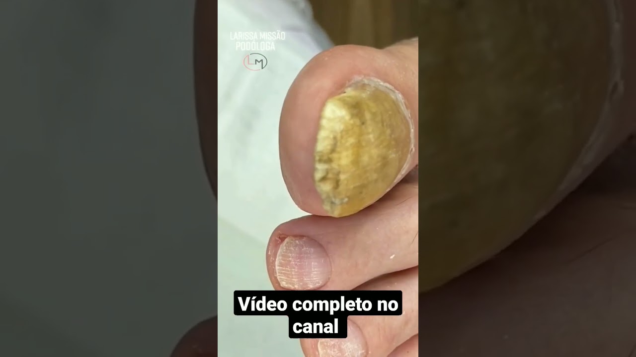 UNHA ESPESSA | ONICOMOCOSE | PODOLOGA LARISSA MISSÃO