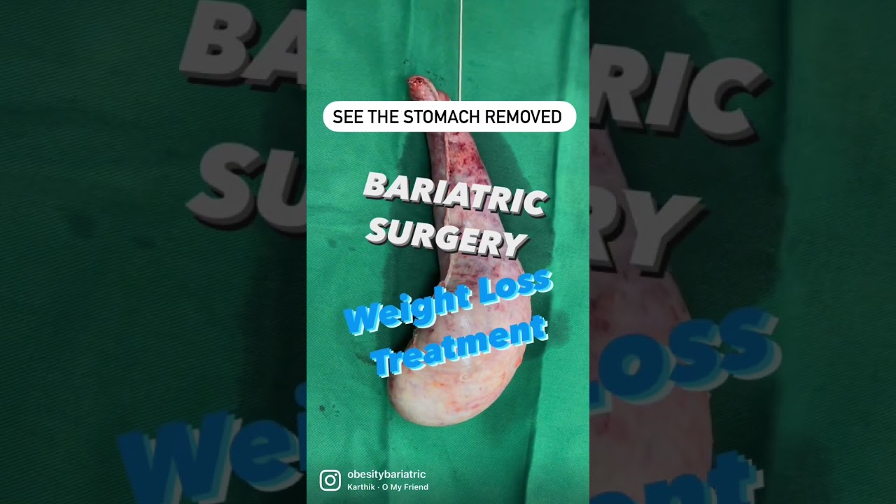 Weight Loss Operation in Surat - Bariatric Surgery In India