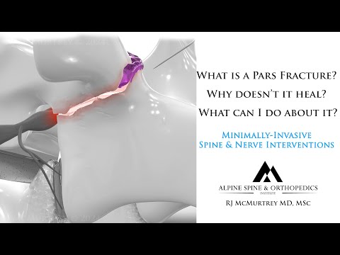 What is a Pars Defect? What are Pars Fracture Treatment Options?  An Overview of New Therapies