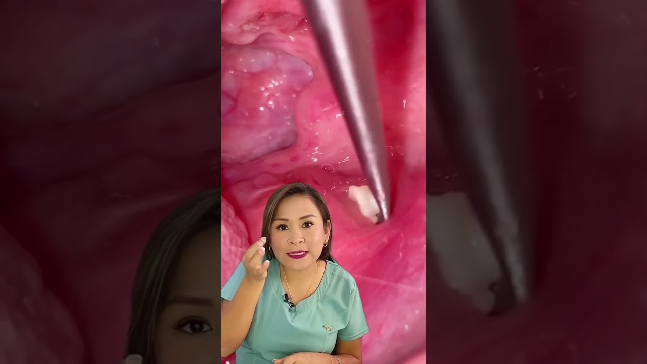 Y tú, ¿las tienes?     #tonsilolitos #garganta #dental #Sonrisasegura